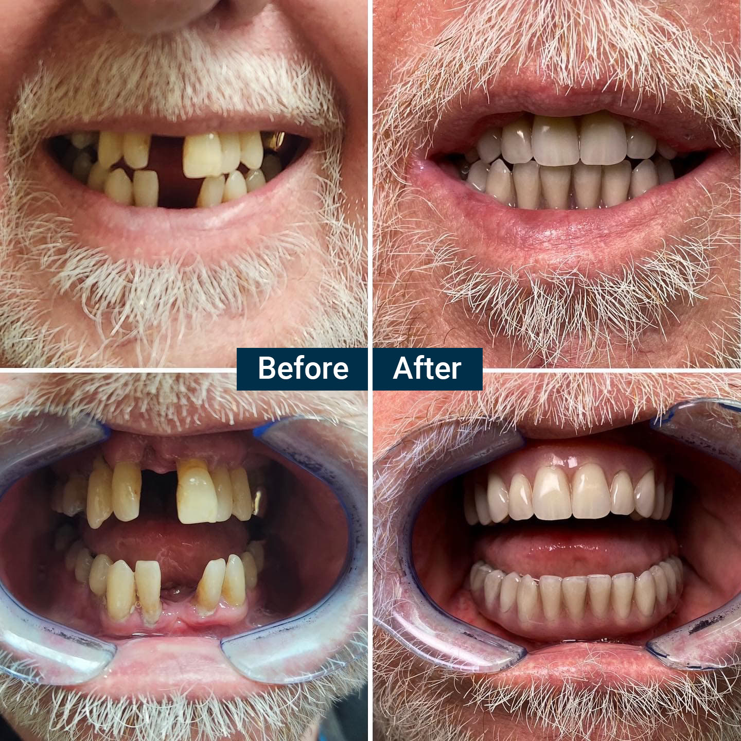 New Teeth Today Before/After