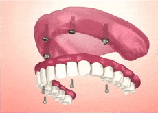 New Teeth Today Model